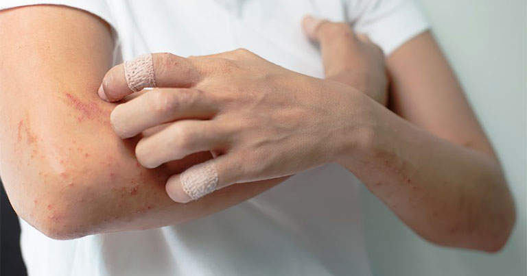 Không cào gãi lên vùng da bị tổn thương để tránh nguy cơ nhiễm trùng, bội nhiễm