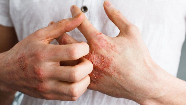 Thói quen cào gãi vùng da bị tổn thương là nguyên nhân gây bội nhiễm