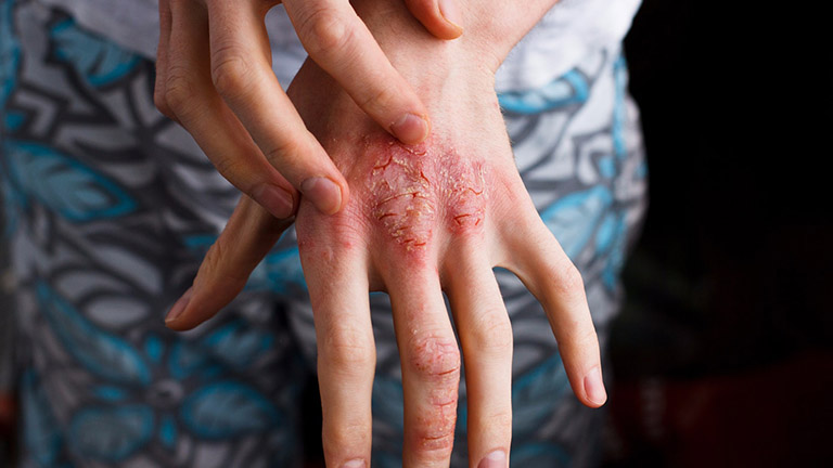 Thực hiện chăm sóc da tại nhà đúng cách giúp hỗ trợ điều trị bệnh