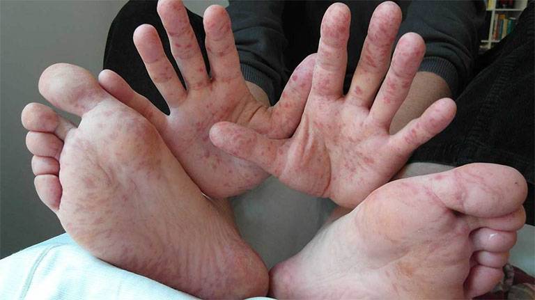 Lòng bàn tay và lòng bàn chân là vị trí dễ khởi phát tổn thương do viêm da cơ địa