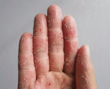 viem-da-co-dia-ngon-tay-mat-dau-van-tay-1