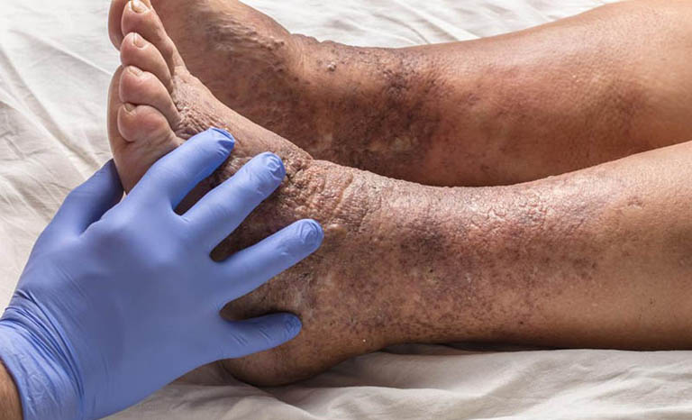 Viêm da cơ địa ở chân không dược điều trị gây thâm nhiễm lan rộng