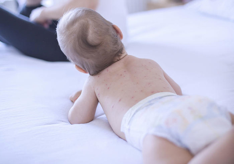 Nổi mề đay là một dạng tổn thương da thường gặp ở trẻ sơ sinh