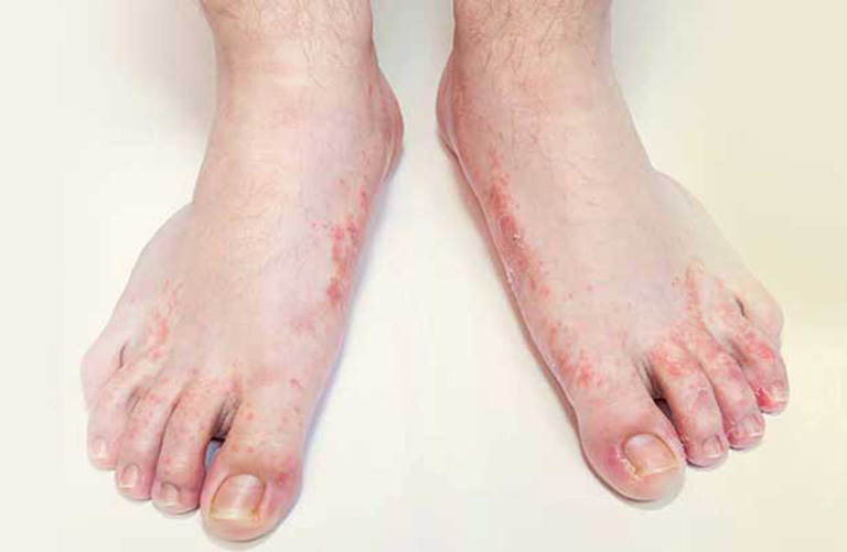 dấu hiệu bệnh tổ đỉa ở tay chân