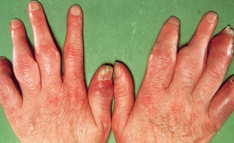 Bệnh vảy nến móng tay, chân có nguy hiểm không?