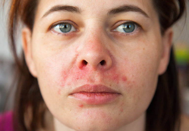 da mặt khô ngứa nổi sẩn đỏ là bệnh gì