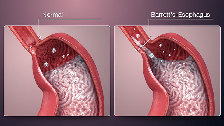 Trào ngược dạ dày độ D thường gây ra biến chứng Barrett thực quản
