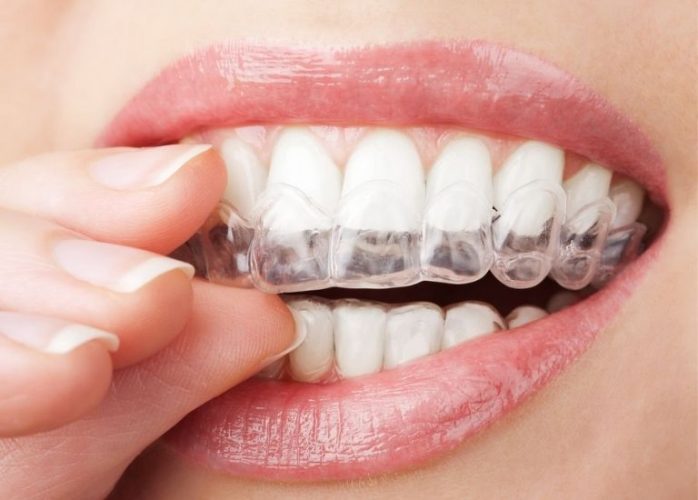 Các loại niềng răng trong suốt: Bật mí ưu điểm và chi phí thực hiện