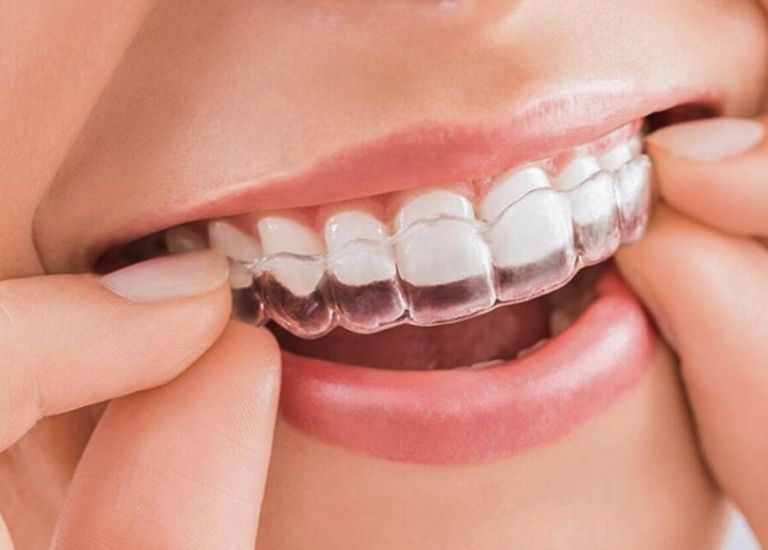 Các loại niềng răng trong suốt ngày càng được nhiều người lựa chọn