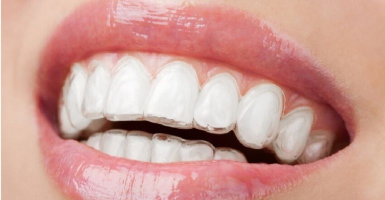 Niềng răng trong suốt loại Clear Aligner được dùng nhiều