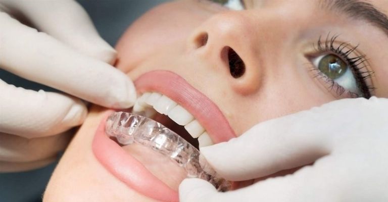 Ecligner là phương pháp được đánh giá cao trong các loại niềng răng tróng suốt hiện nay