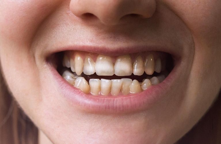 Mòn men răng gây nên tình trạng vàng ố, mất thẩm mỹ