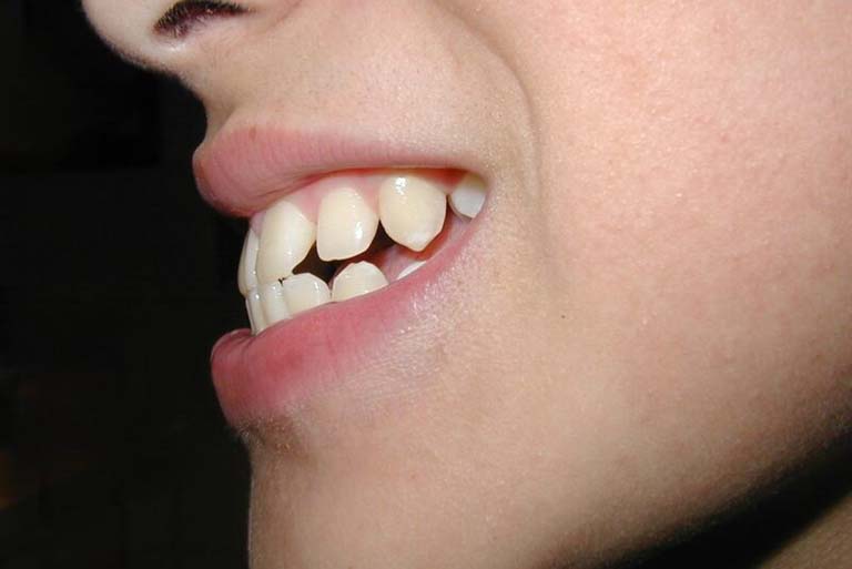 Biện pháp chỉnh nha này giúp khắc phục nhanh chóng tình trạng răng hô, móm, mọc lệch lạc, khấp khểnh,... cho người bệnh