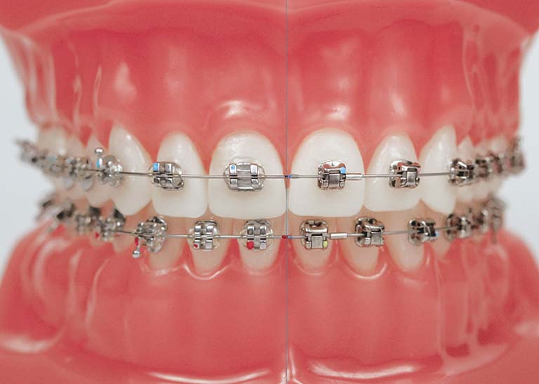Hiện nay công nghệ ngày càng hiện đại nên có rất nhiều phương pháp niềng răng cho người bệnh lựa chọn
