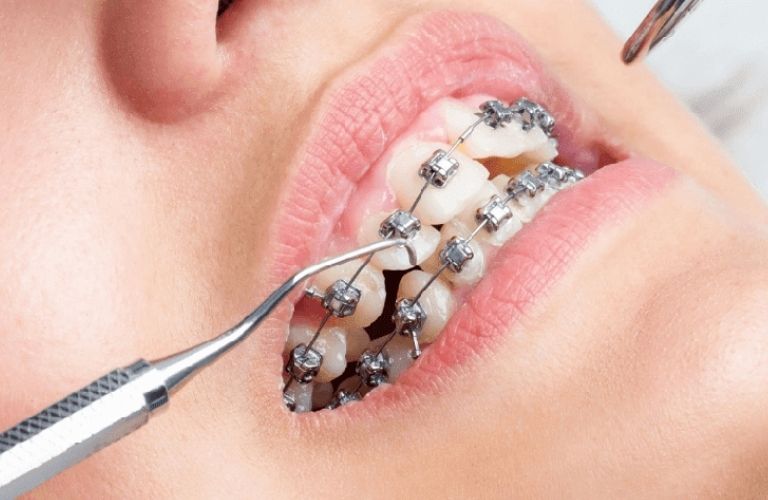 Bạn cần thực hiện đầy đủ theo quy trình niềng răng chuẩn nhằm tránh các tác hại không tốt xảy ra