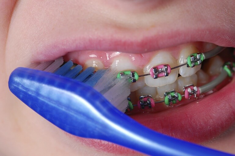 Bên cạnh thói quen ăn uống, bạn cần biết cách vệ sinh răng sạch sẽ