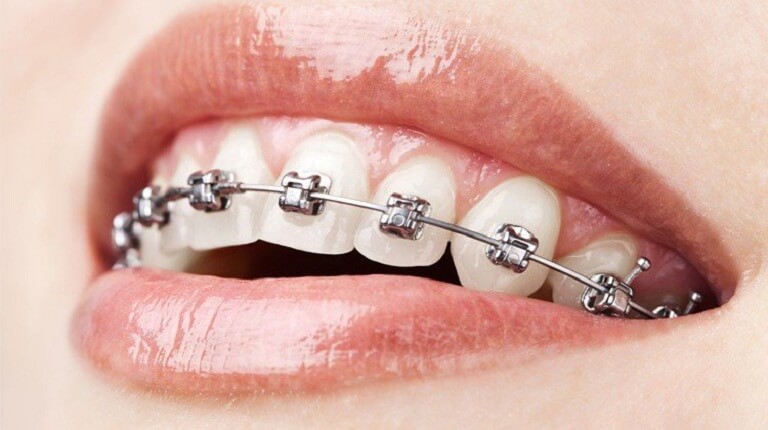 Trên thực tế thống kê các ca điều trị, niềng răng không nhổ chiếm đa số hơn