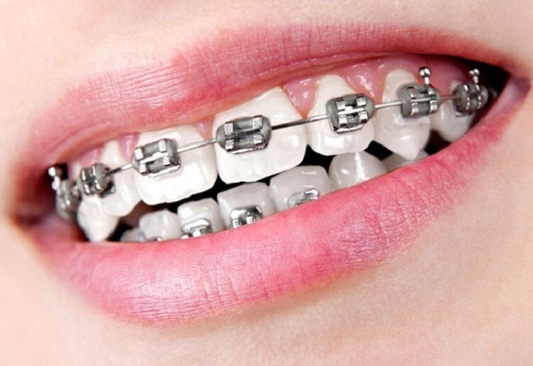 Niềng răng mắc cài tự buộc là một trong những biện pháp chỉnh nha hiện đại nhất hiện nay