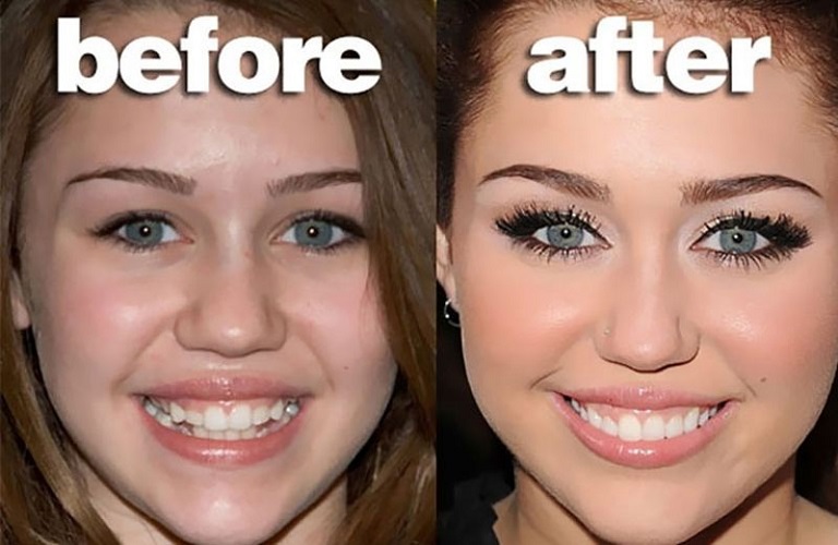 Trong nhiều trường hợp, người niềng răng đã có thể thay đổi cuộc đời nhờ có nụ cười tự tin hơn