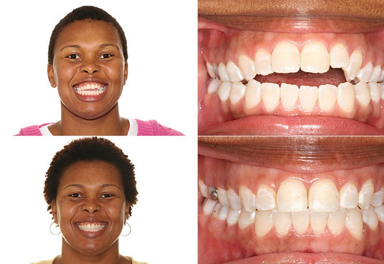 Niềng răng thay đổi khuôn mặt trở nên cân đối hơn