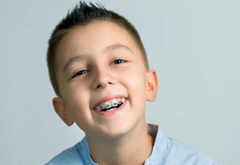 Nên cho trẻ thực hiện niềng răng trước khi bước qua tuổi 16