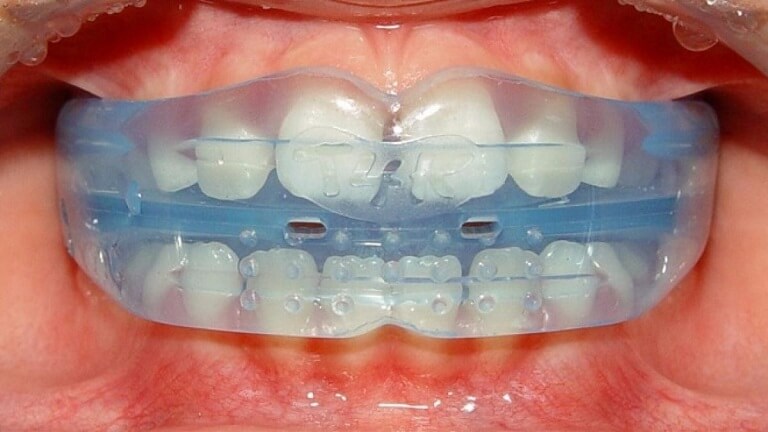 Niềng răng Trainer là một khay silicon, có tác dụng nắn chỉnh hàm răng tại nhà