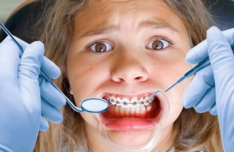 Niềng răng xong bị móm là một nguy cơ có thể xảy ra trong quá trình chỉnh nha