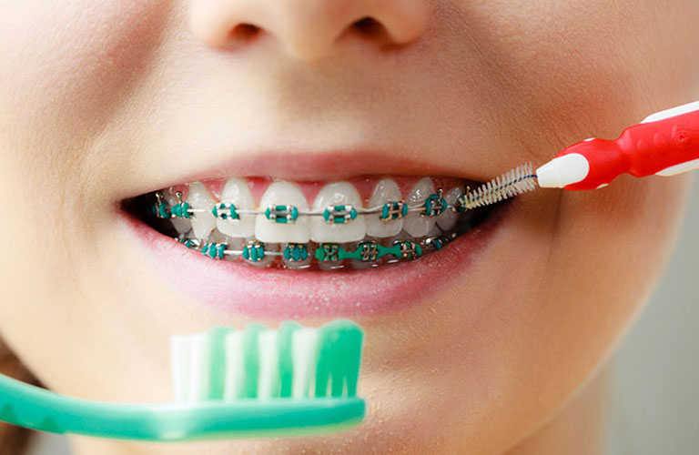 Vệ sinh răng miệng đúng cách để ngăn ngừa niềng răng xong bị móm