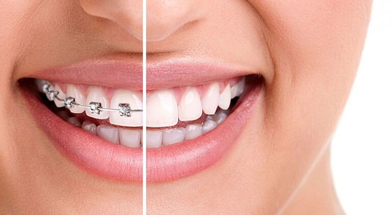 Một quá trình niềng răng cơ bản gồm có 7 bước thực hiện