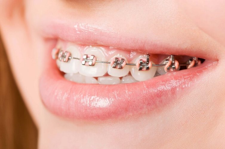 Quá trình niềng răng được diễn ra qua nhiều bước khác nhau