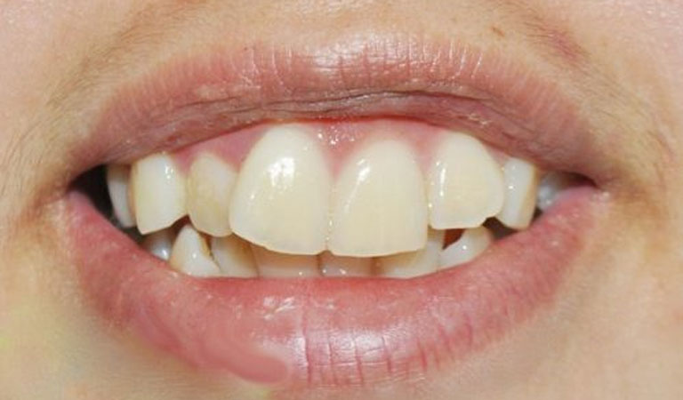 Răng lệch nhân trung có thể do nhiều nguyên nhân khác nhau