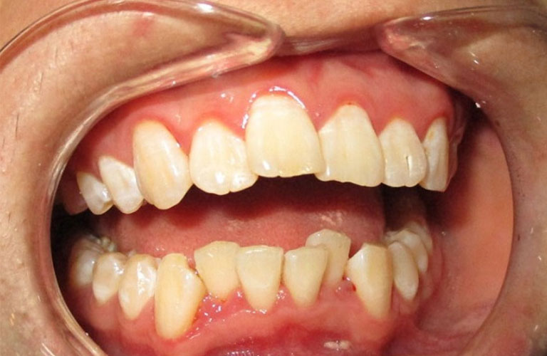 Răng lệch nhân trung cũng là một biến chứng có thể xảy ra sau niềng răng