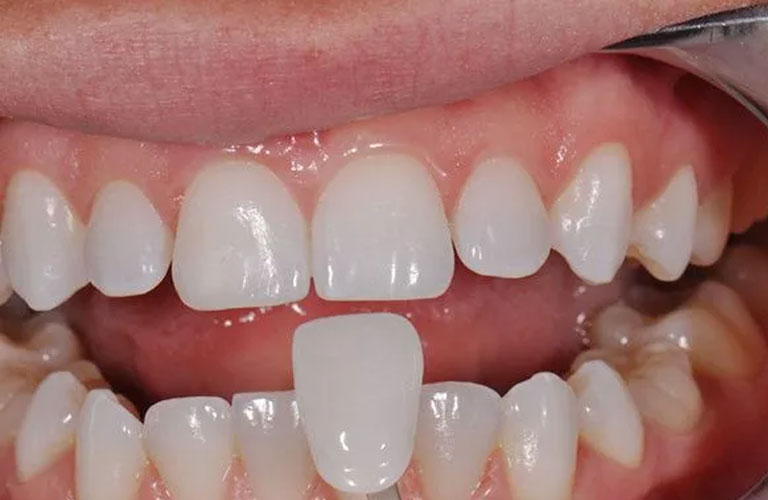 Hình ảnh thực tế phương pháp bọc răng sứ