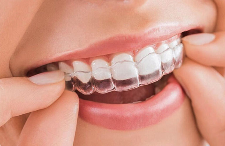 Niềng răng trong suốt là phương pháp hiện đại khắc phục răng lệch nhân trung