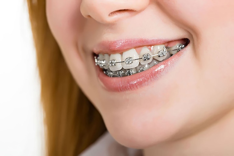 Các loại thun niềng răng phổ biến hiện nay