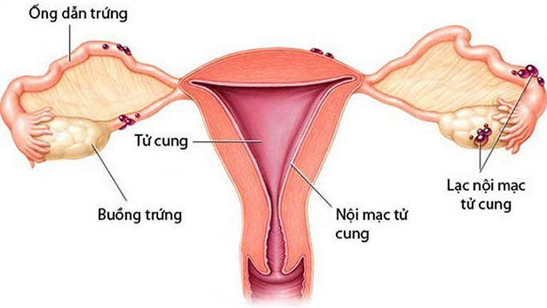 U lạc nội mạc tử cung là gì, bệnh có nguy hiểm không? Các phương pháp đẩy lùi bệnh hiệu quả