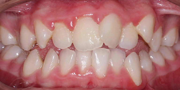 Răng mọc lệch mang đến nhiều tác hại cho người bệnh