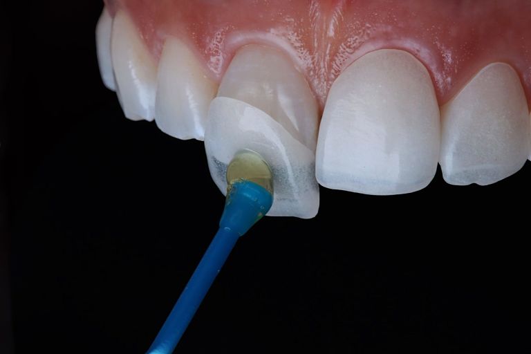 Giá bọc răng sứ còn tùy thuộc vào chất liệu bọc răng, sức khỏe răng miệng