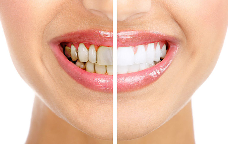 Bọc răng sứ giúp cải thiện tình trạng răng ố vàng, xỉn màu