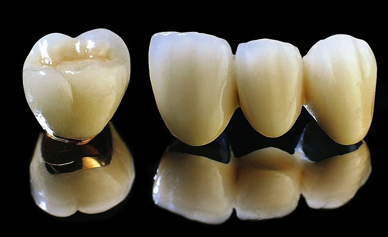 Răng sứ Titan có cấu tạo lớp sườn bên ngoài từ hợp kim Titan