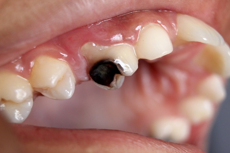 Hiện tượng sâu răng là bệnh lý có thể xảy ra ở mọi lứa tuổi