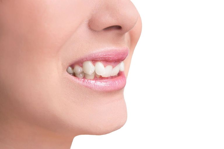 Niềng răng khểnh khi răng mọc lệch quá mức làm ảnh hưởng đến việc ăn nhai