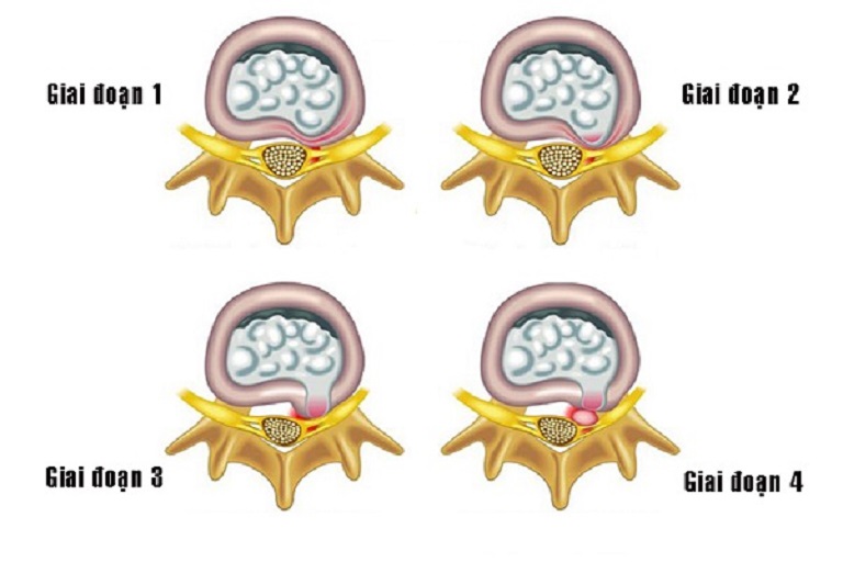 các giai đoạn thoát vị đĩa đệm