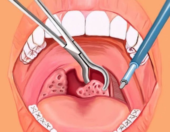 Cắt amidan có nguy hiểm không? Người bệnh khi bị viêm amidan thường rất lo lắng điều này