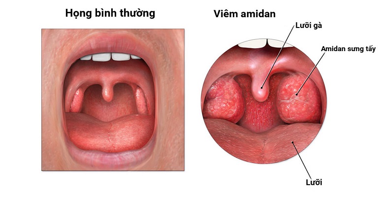 Cắt amidan ở đâu là vấn đề nhiều người quan tâm