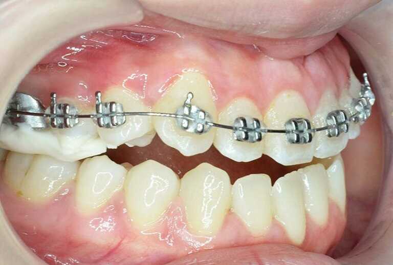 Kỹ thuật niềng răng 1 hàm tùy thuộc vào mức độ sai lệch của răng
