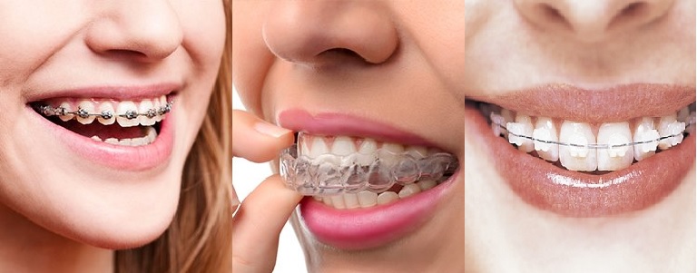 Các phương pháp niềng răng 1 hàm và 2 hàm phổ biến