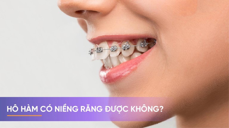 Răng bị hô hàm có niềng được không là thắc mắc của rất nhiều người