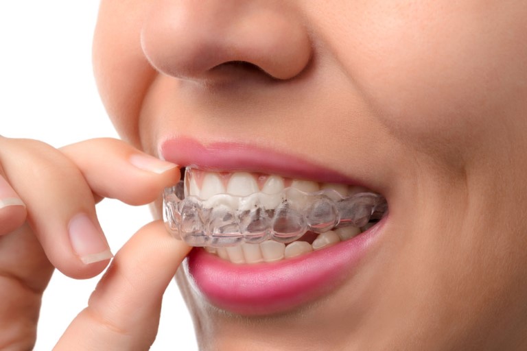 Chi phí niềng răng hô hàm phụ thuộc vào nhiều yếu tố khác nhau