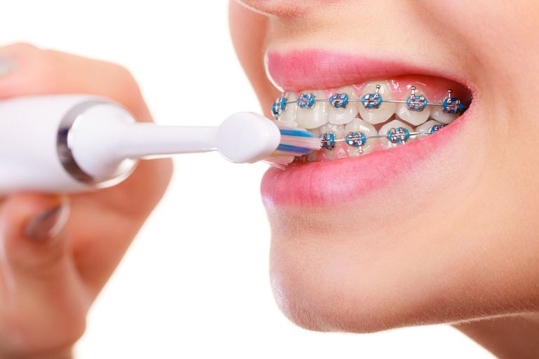 Bạn lưu ý chăm sóc răng miệng cẩn thận trong quá trình niềng răng